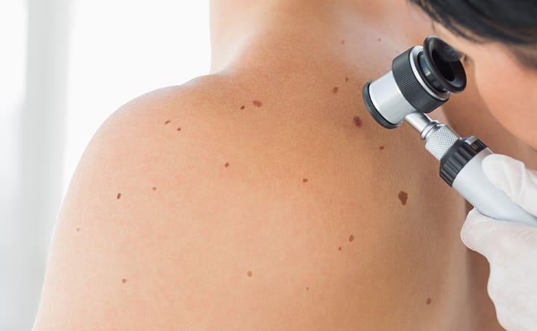 Understanding Melanoma: Early Signs and How to Protect Your Skin Naturally